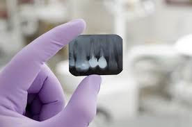 Radiografias Intra-Bucais